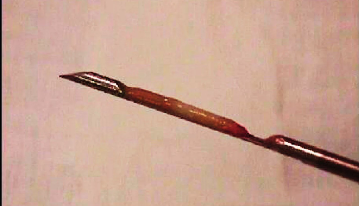 Tkáňové vzorky se odebírají 14G jehlou délky 10 cm