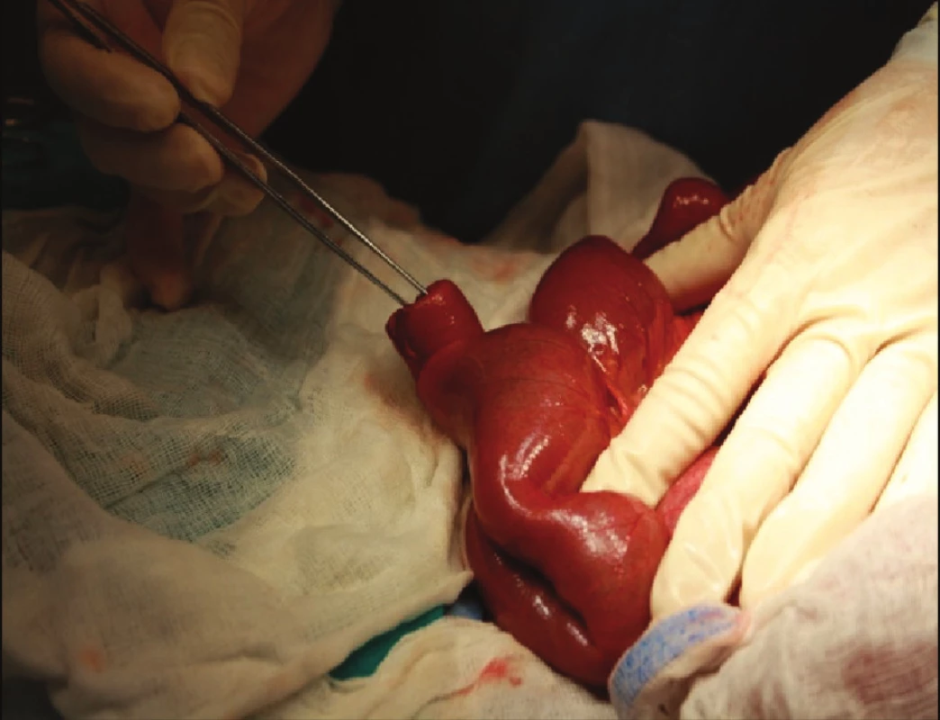 Perioperačný nález invaginovaného Mekelovho divertikula
Fig. 1. Perioperative finding of invaginated Meckel´s diverticulum