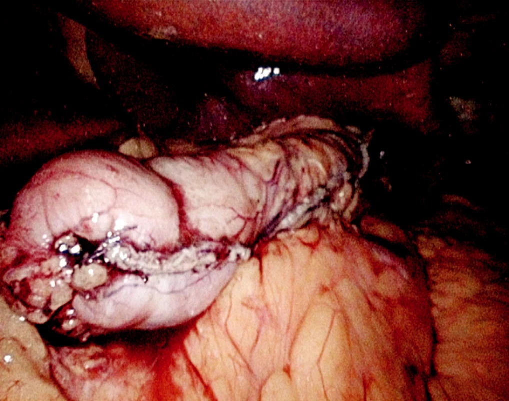 Resekční linie
Fig. 4. Resection line