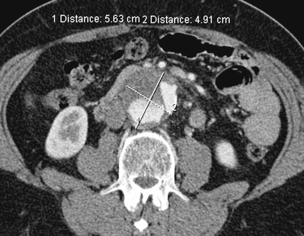 Aneuryzmatická dilatace nepravého lumen subrenálně
Pic. 15. Subrenal aneurysmatic dilation of the false lumen