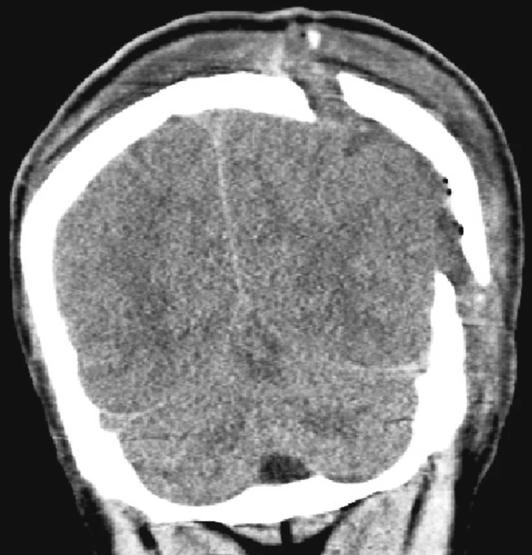 Šikmý řez Gigliho pilkou zamezující vpadnutí kostní ploténky po ústupu edému mozku
Fig. 1. Aoblique cut using a Gigli saw, preventing a bone plate from falling in, following resolution of brain edema