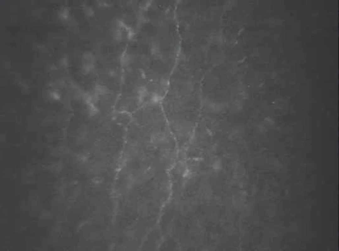 Nervová vlákna subbazálního nervového plexu u pacienta s diabetem mellitus 1. typu a pokročilou proliferativní diabetickou retinopatií
Fig. 2. Corneal sub-basal nerve fibers of a patient with advanced proliferative diabetic retinopathy.