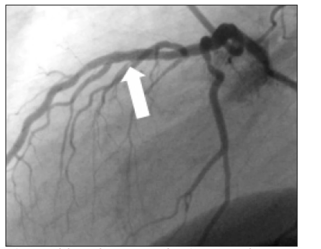 Selektivní koronarografie v boční projekci po PCI implantaci stentu ukazuje optimální nález na intervenovaném místě (šipka).