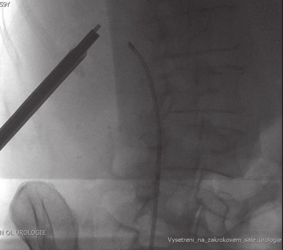 Kombinovaný intrarenální přístup – ECIRS (flexibilní ureterorenoskopie + perkutánní nefrolitotrypse) – peroperační RTG
Fig. 3. Combined intrarenal approach – ECIRS (flexible ureterorenoscopy + percutaneous nephrolithotripsy) – X-ray during surgery