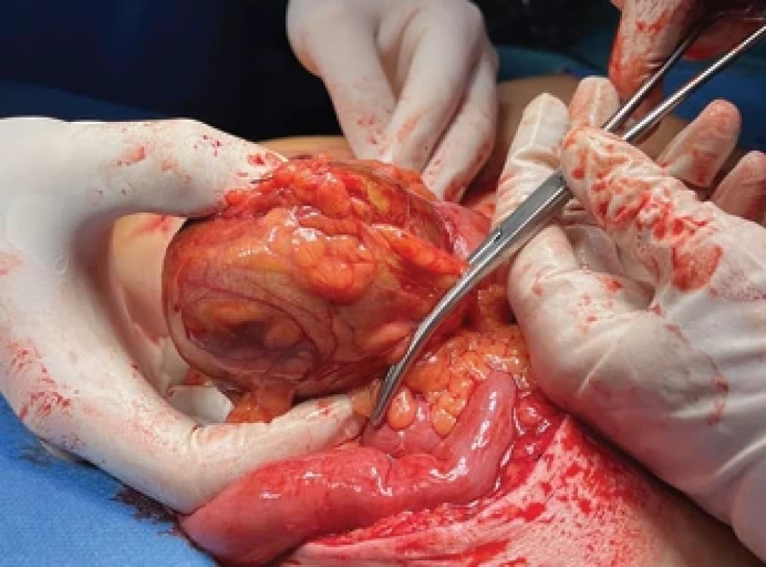 Peroperační nález. Fig. 6. Intraoperative fi nding.