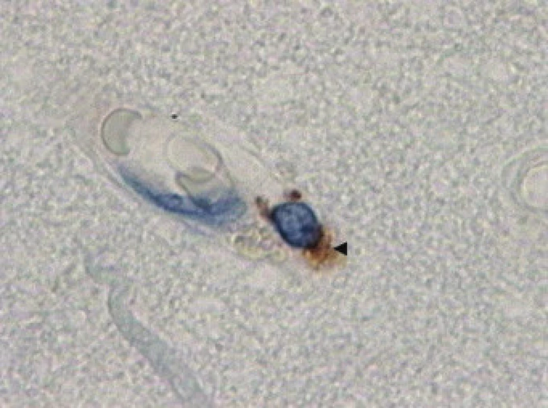 Imunohistochemická reakce s protilátkou proti antigenu CD 68 (◄ ) zbarvení značí pozitivní reakci navázané protilátky s DAB (diaminobenzidinem), zvětšení 400×.