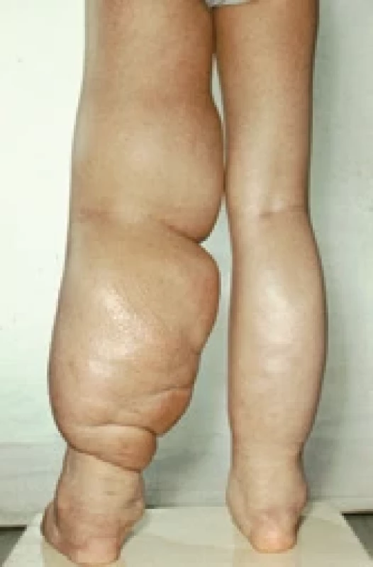 Elephantiasis of left lower limb.
