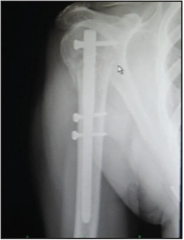 Nitrodřeňová osteosyntéza proximálního humeru