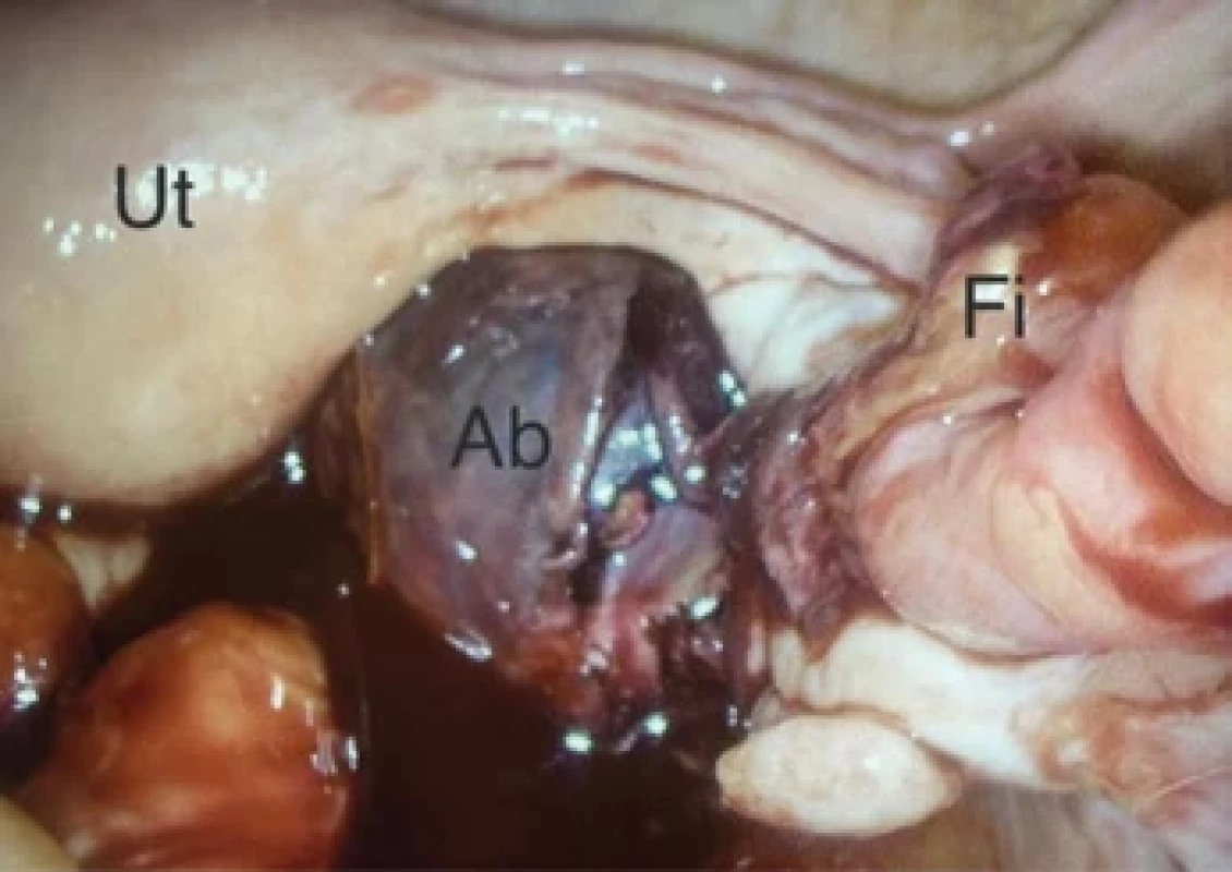 Fotografie peroperačního nálezu s vyznačenými strukturami.</br>Fig. 4. Photograph of intraoperative findings with marked structures.