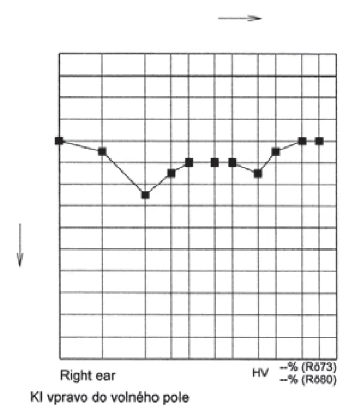 Zisková křivka se zapojeným procesorem – tři roky po CI. Hearing threshold level with processor on – three years after CI.