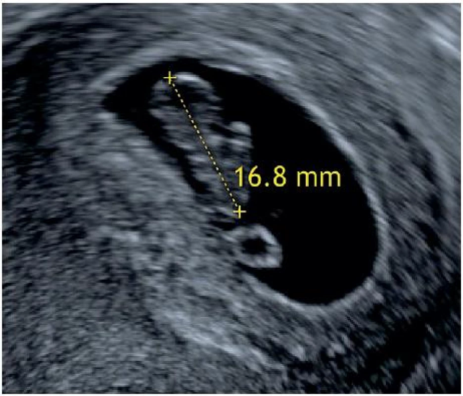 Průkaz neprosperující intrauterinní gravidity (embryo bez srdeční akce o CRL ≥ 7 mm)
Ultrazvukové zobrazení gestačního váčku s embryem bez patrné pulzace (srdeční akce) o maximální délce (CRL) 16,8 mm (odpovídá grav. hebd. 8+1).