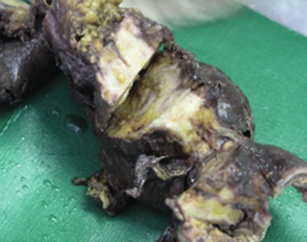 Makroskopické pitevné nálezy poukazujú na rozsah a hrúbku osifikácie zostávajúcej časti čreva
Fig. 5: Macroscopic autopsy findings indicate the extent and thickness of ossification of the residual part of the intestine