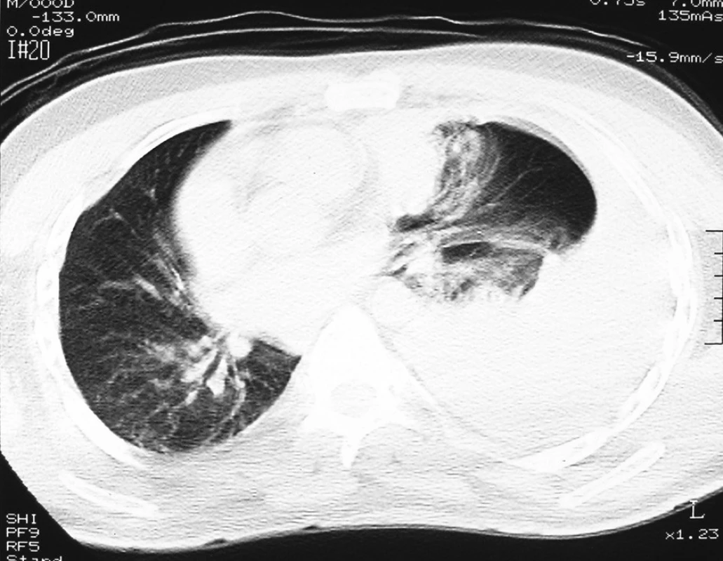 CT hrudníku, levostranný hemotorax
Fig. 3. CT of chest, haemothorax on the left side