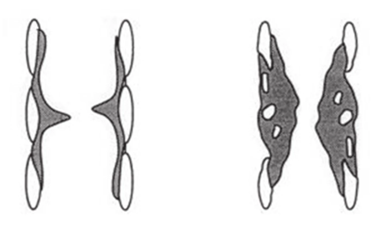 Stenózy trachey
Fig. 1: Types of tracheal stenoses