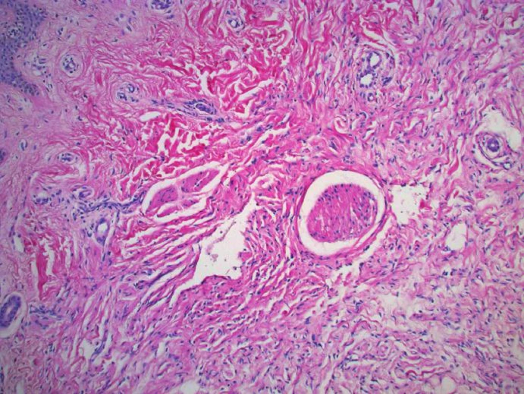 Neurofibrom kolem nervového svazku, tvořený jemnými kolagenovými vlákny a vřetenitými buňkami s přítomností sešikovaných jader (HE, zvětšení 20krát)