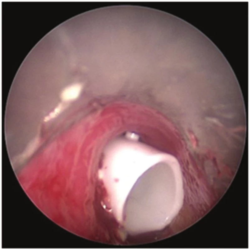 Bronchoskopický pohled: Dumonův stent v trachey
Fig. 6: Bronchoscopic view: Dumon stent in the trachea