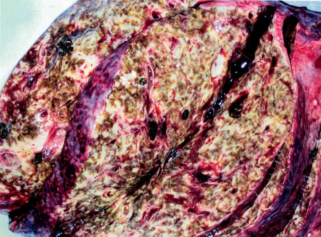 Preparát resekovaných jater na řezu s hepatolitiázou, těžkou cirhózou a hnisáním v segmentárních žlučovodech
Fig. 2. Preparation of the resected liver, the section revealing hepatolithiasis, severe cirrhosis and suppuration in the segmental bile ducts
