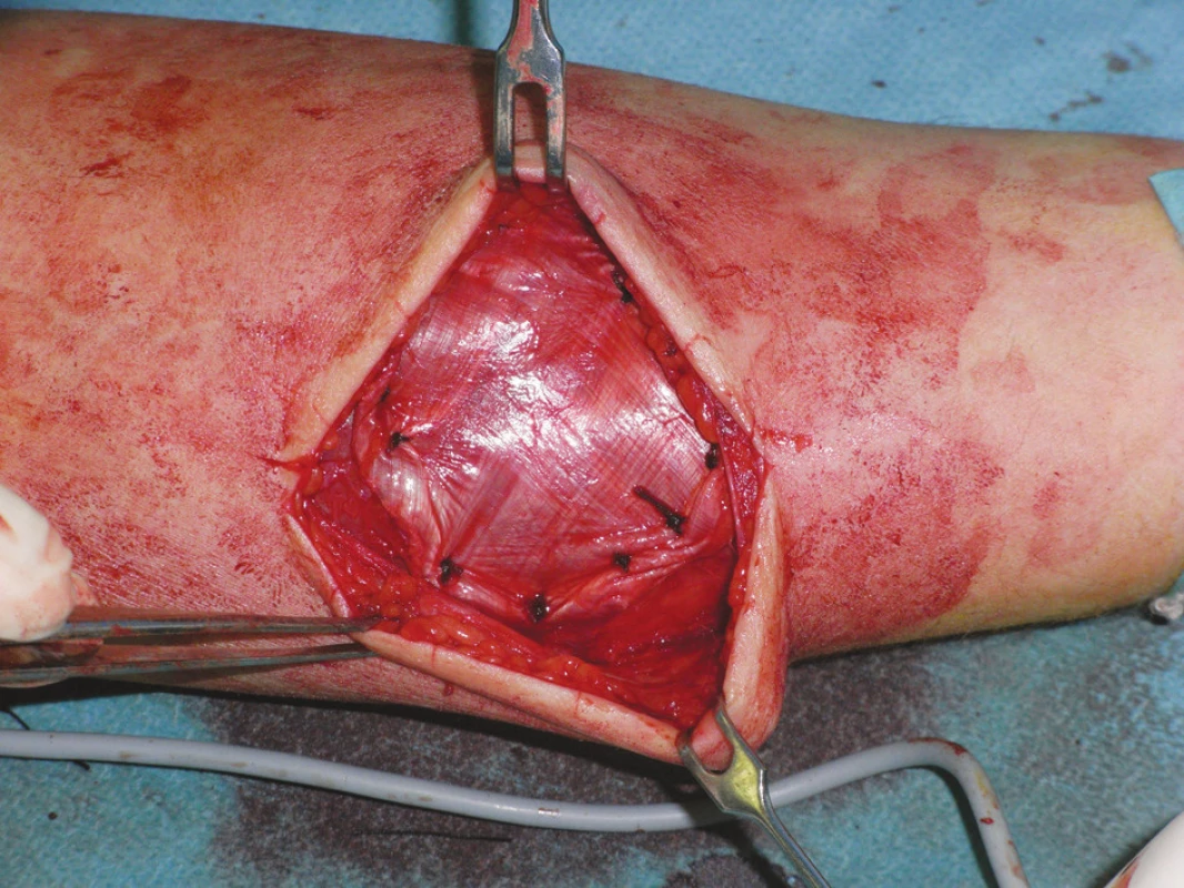 Onlay plastika hernie predlaktia
Fig. 3. Onlay- plasty of the forearm hernia