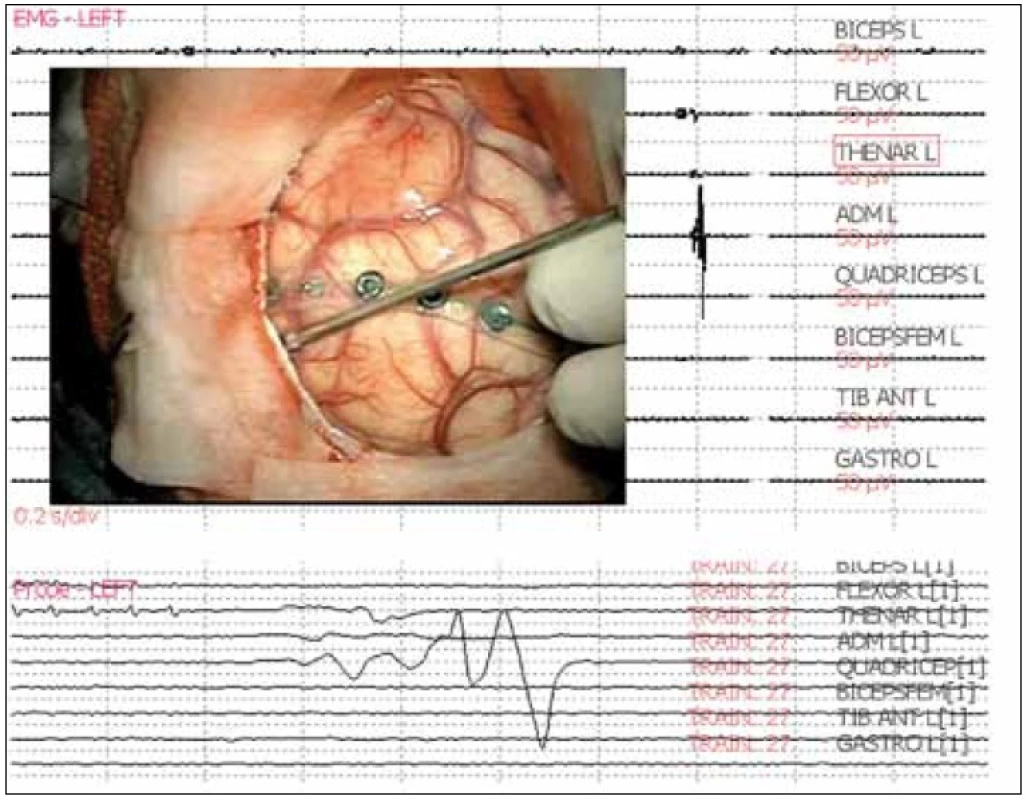 EMG odpoveď v m. adductor digiti minimi (ADM) na bipolárnu stimuláciu precentrálneho gýru spôsobom train s frekvenciou opakovania 1 Hz, záznam na trigerovanom a free running EMG.