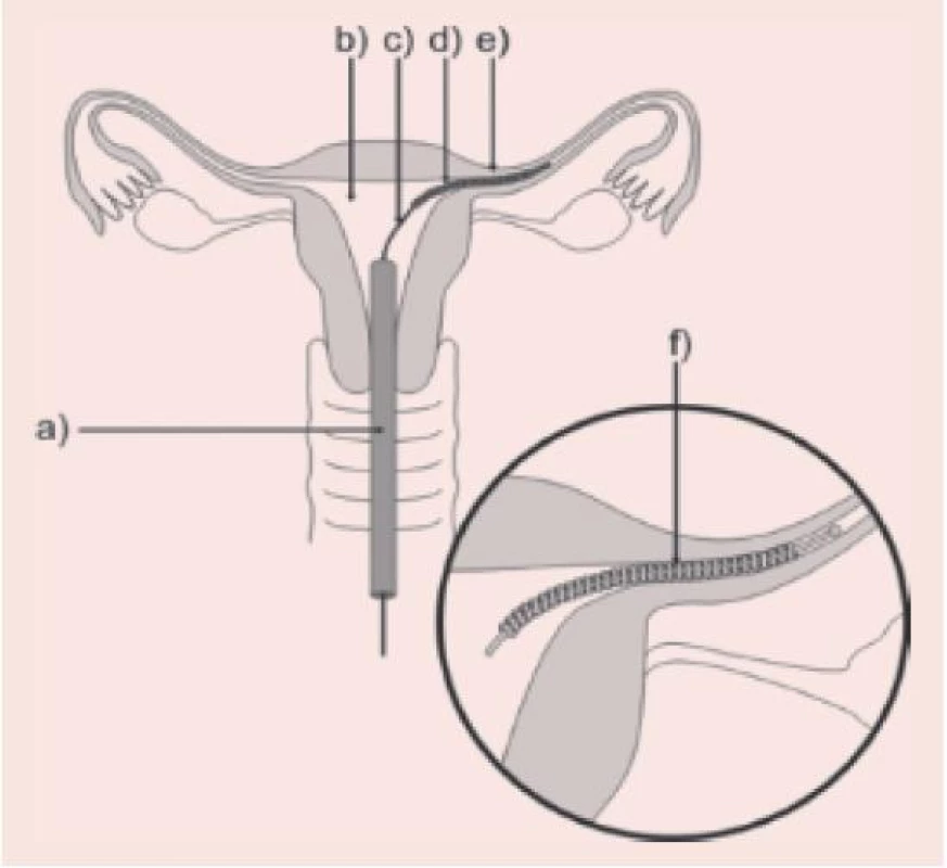 Zavádění implantátu Essure