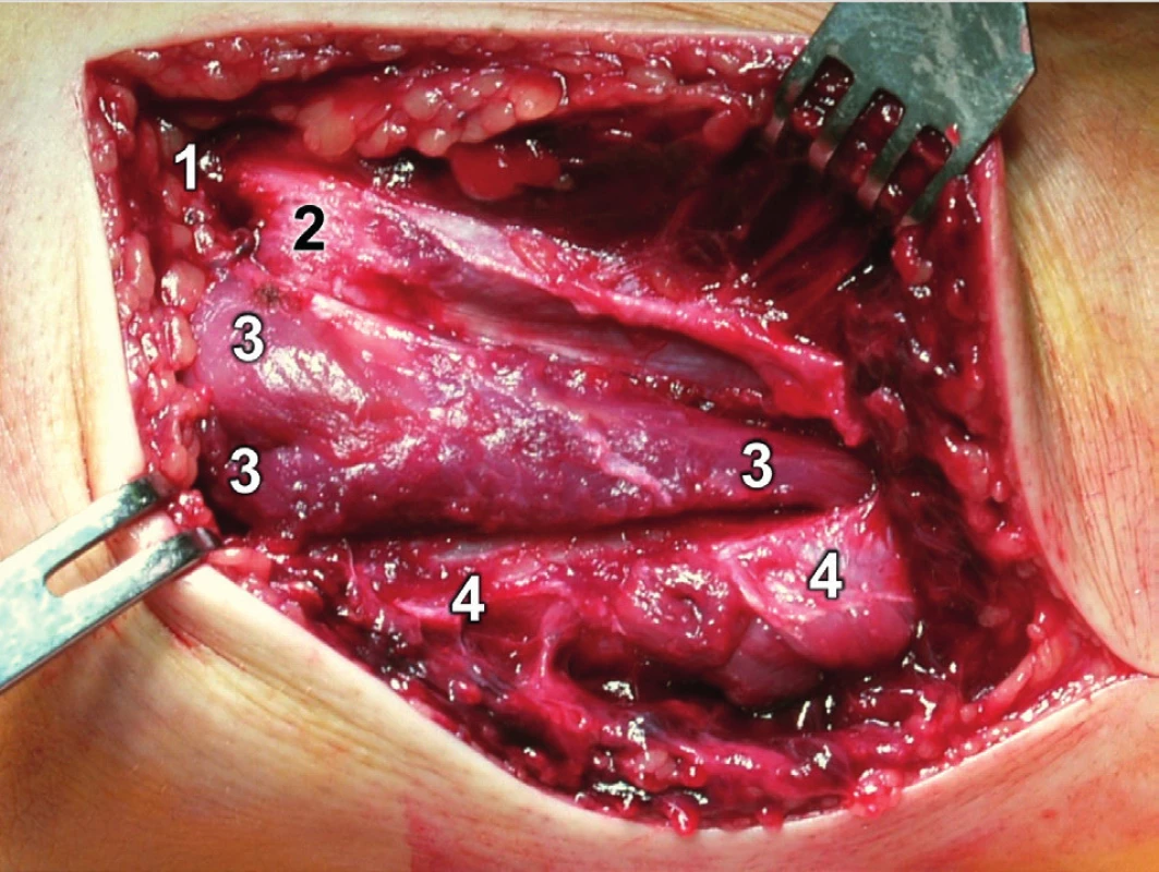 Rozšířený modifikovaný Kocherův přístup – preparace m. anconeus: 1 – epicondylus lateralis humeri, 2 – kloubní pouzdro, 3 – anconeus, 4 – ulna.
Fig. 14: Extended modified Kocher approach – dissection of anconeus: 1 – lateral epicondyle of humerus, 2 – joint capsule, 3 – anconeus, 4 – ulna.

