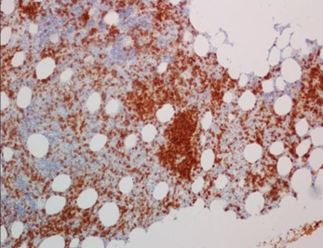 Histologie kostní dřeně před léčbou (FNHK, Fingerlandův ústav patologie) – imunohistochemický průkaz antigenu CD23, pozitivita nádorových buněk (CLL), až 50 % z celkové buněčnosti.