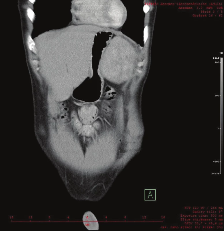 Na CT frontálním řezu je patrný útlak žaludku ložiskem v levém subfreniu
Fig. 3: A frontal CT scan showing apparent compression of the stomach by the tumor