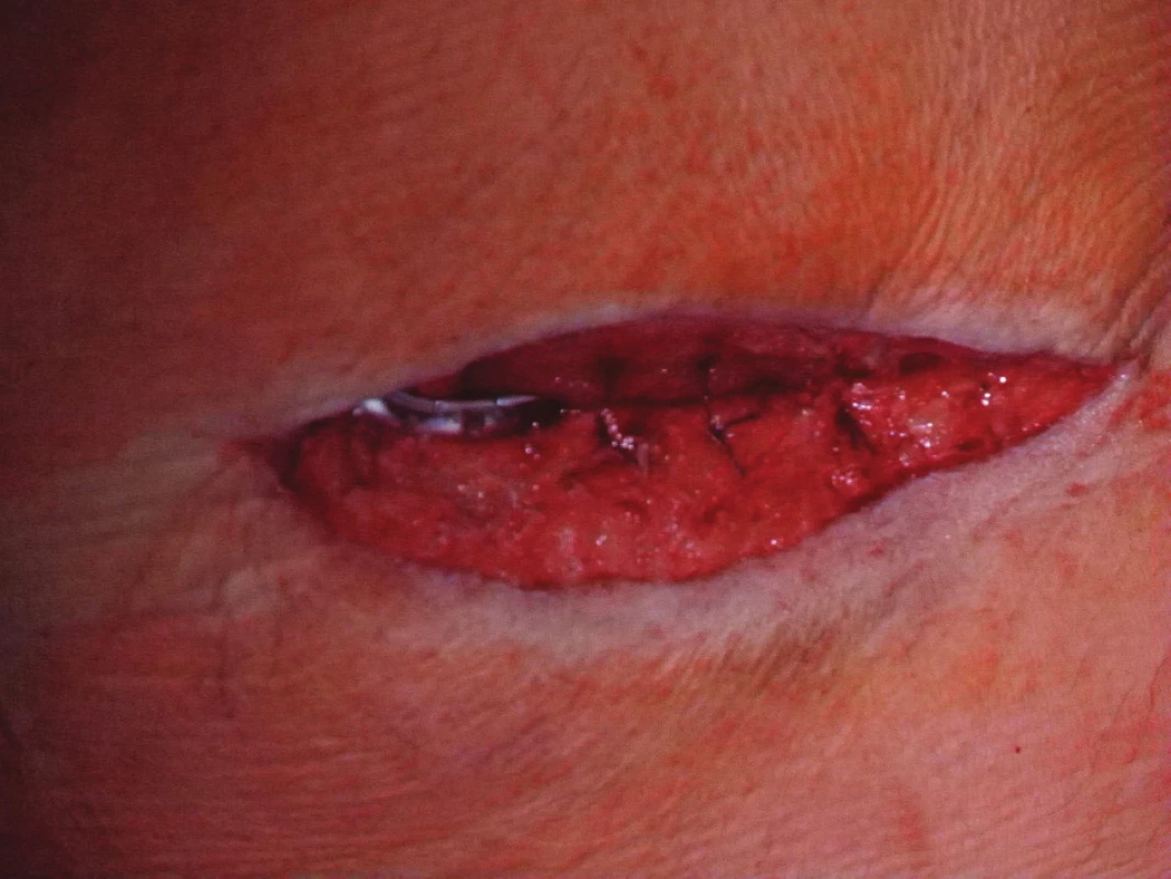Uzávěr rány s Redonovou drenáží
Fig. 3: Closure of the wound using Redon´s drains
