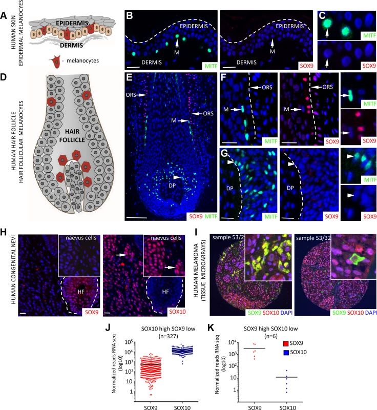 Differential expression of SOX10 and SOX9 in human melanocytes, human giant congenital naevi and human melanoma samples.