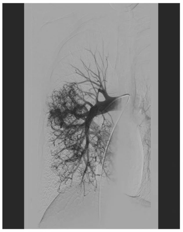 Plicní angiografie zobrazující difúzní postižení
dolního plicního laloku vpravo s mnohočetnými převážně
drobnými AV zkraty<br>
Fig. 3: Pulmonary angiography: diffuse involvement of
the right lower lobe with multiple, predominantly minor
AV shunts