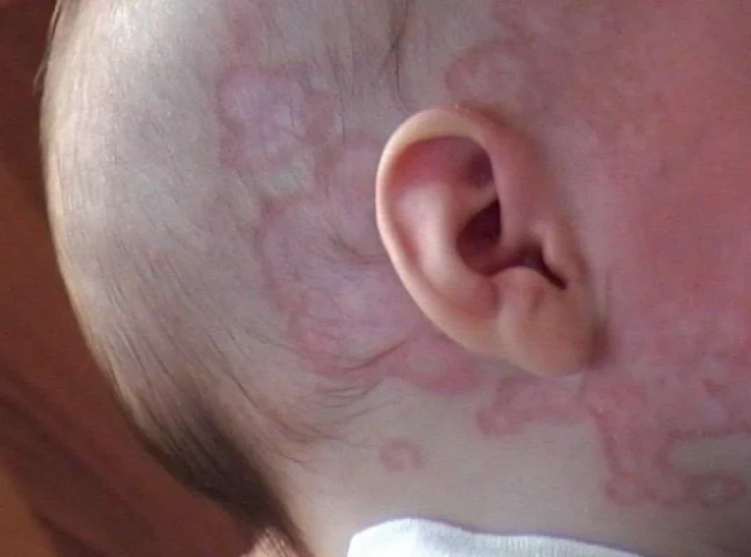 Neonatální lupus erythematodes