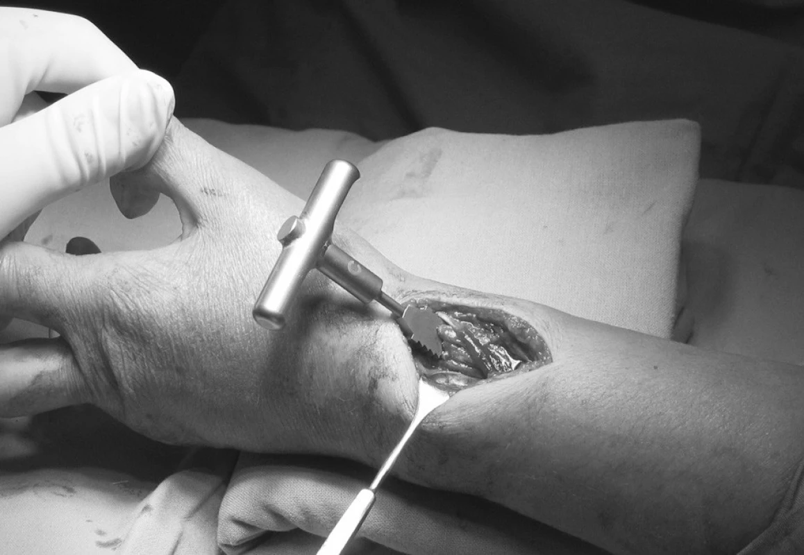 Operační přístup po zavedení rašple
Fig. 2. Surgical approach following introduction of a rasp