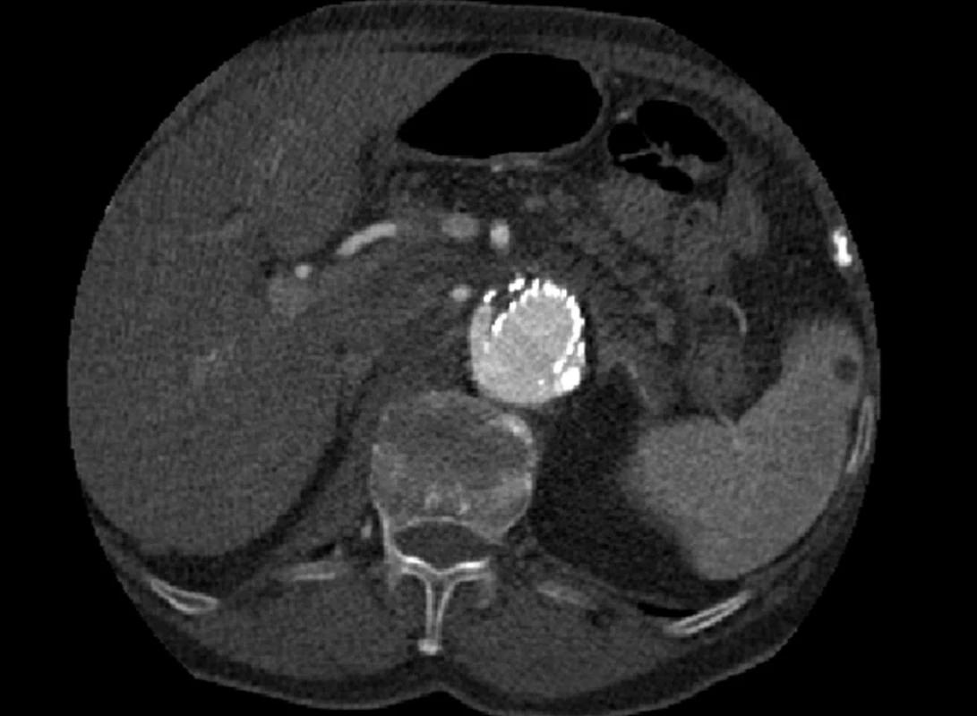 CTA obraz proximálního endoleaku I. typu
Fig. 5: CTA image of the proximal type I endoleak