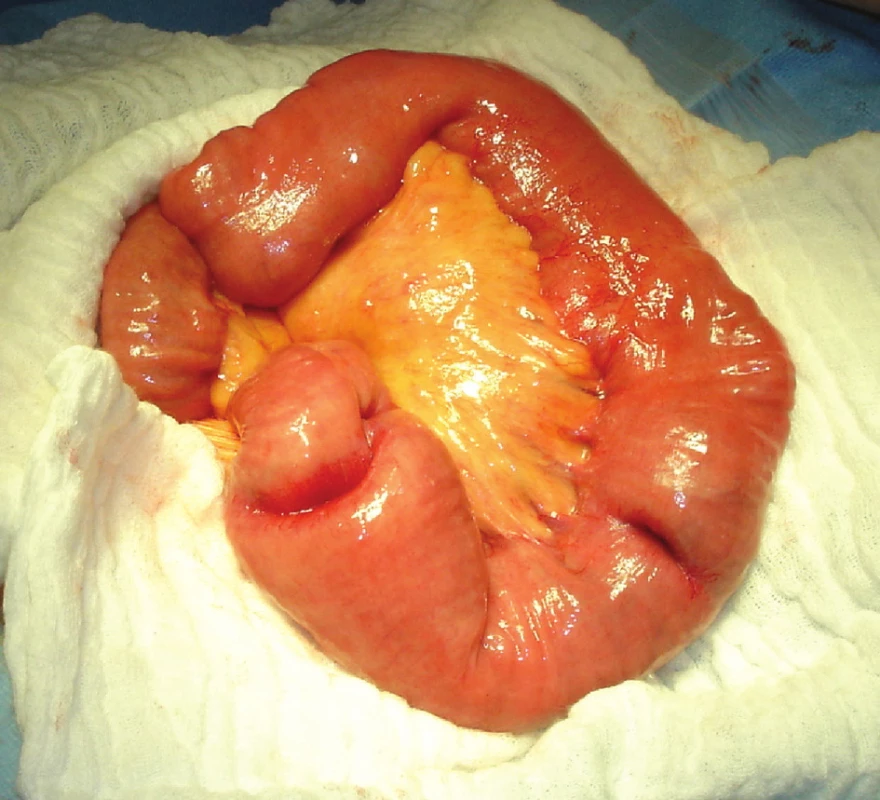 Invaginace jejuna
Fig. 7. Jejunal invagination