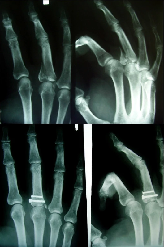 Intraartikulární zlomenina proximální epifýzy typu B (a) s osteosyntézou samostatnými šrouby (b)