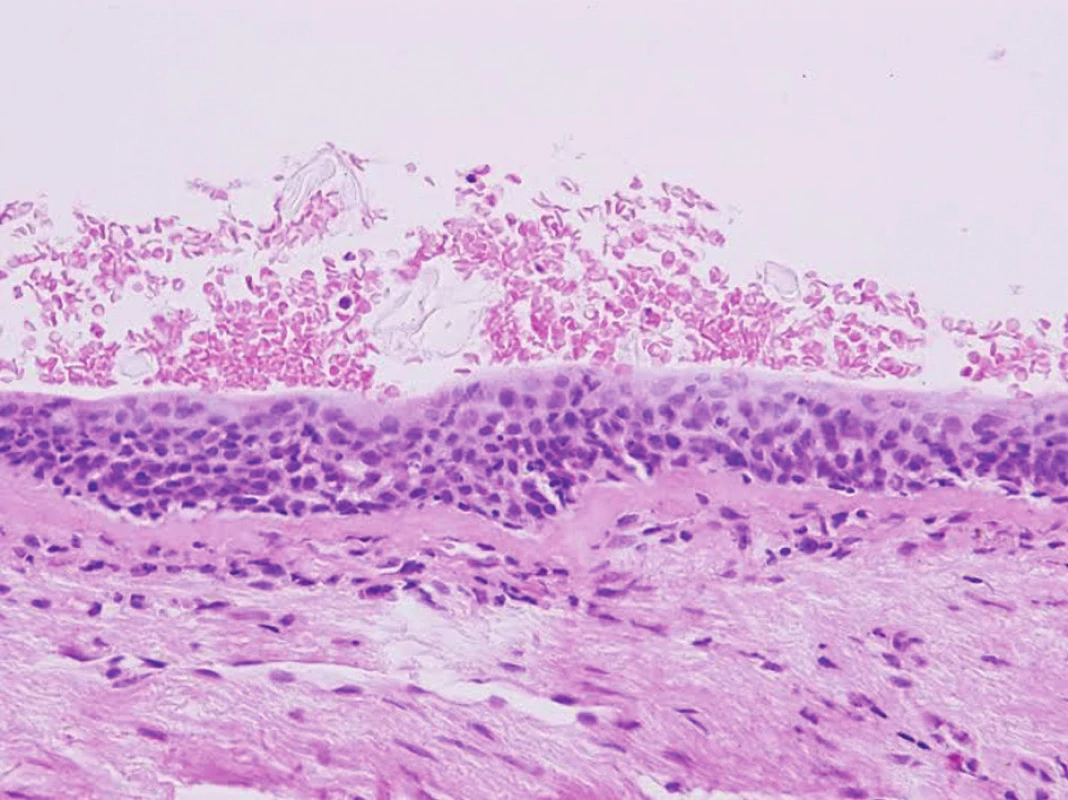 Dysplázie dlaždicobuněčného metaplastického epitelu resekční linii bronchu
Původní zvětšení 400x, přehledné barvení hematoxylin-eosin. 
Fig. 3: Dysplasia of squamocellular metaplastic epithelium in bronchial resection margin. Original magnification 400x, hematoxylin-eosin stain. 