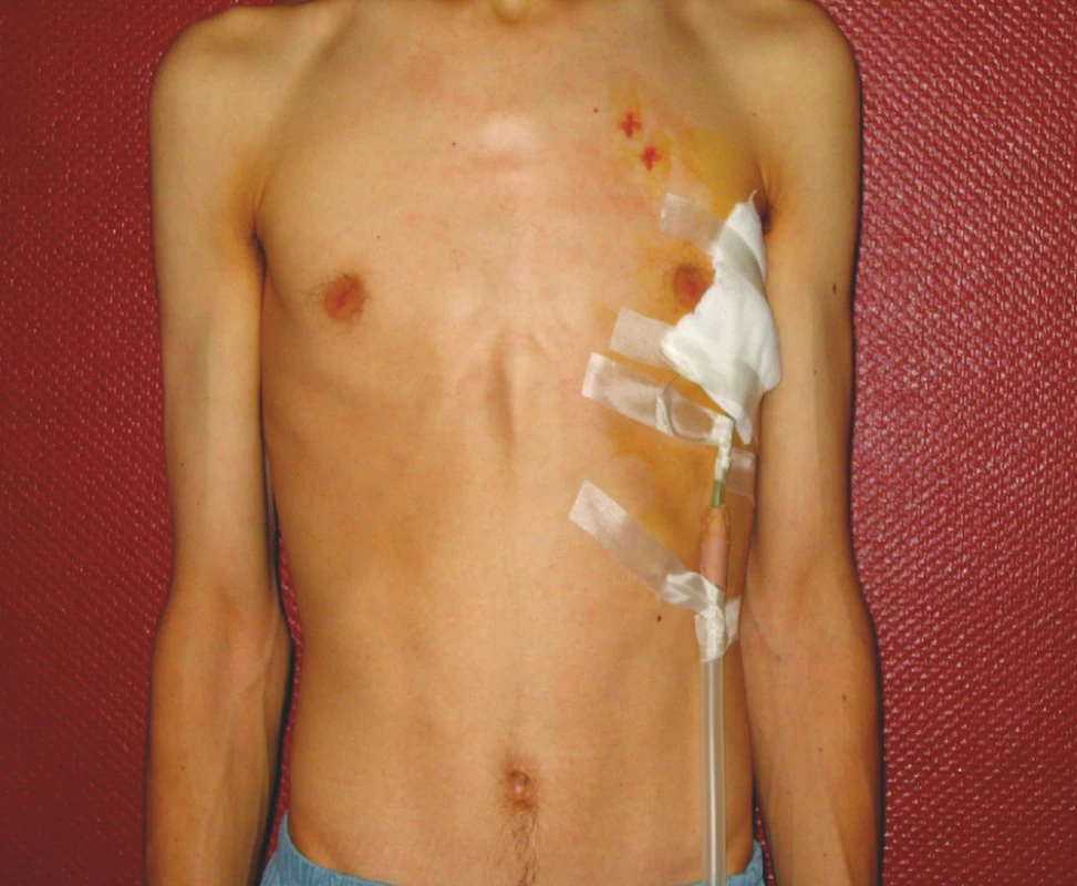 Hrudní drenáž vlevo, mladý pacient, štíhlý, dlouhý hrudník
Fig. 1. Drainage of the thorax, young man, long slight thorax