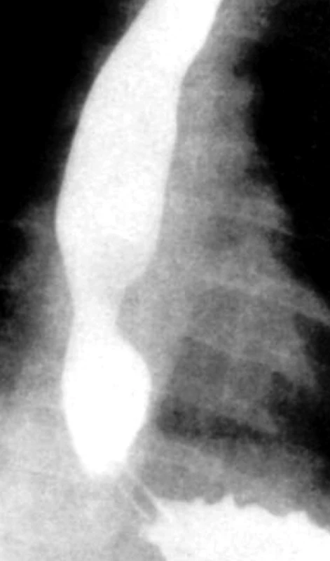 Refluxní striktura po pooperační dilataci.
Fig. 2.Reflux stricture after postoperative dilation.