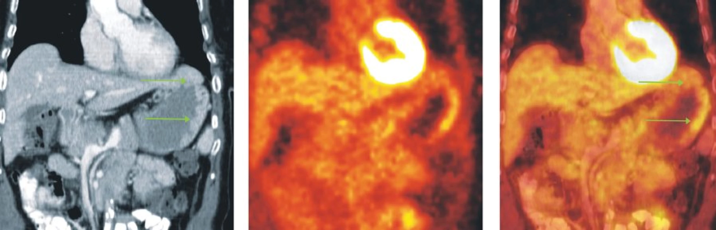 Snímky výpočetní tomografie (CT), pozitronové emisní tomografie (PET) a PET/CT u nemocné s MZL MALT lymfomem žaludku. Na CT skenech je nepravidelně infiltrovaná a zesílená stěna žaludku zejména v oblasti fundu a velké kurvatury, která vykazuje mírně zvýšenou akumulaci FDG.