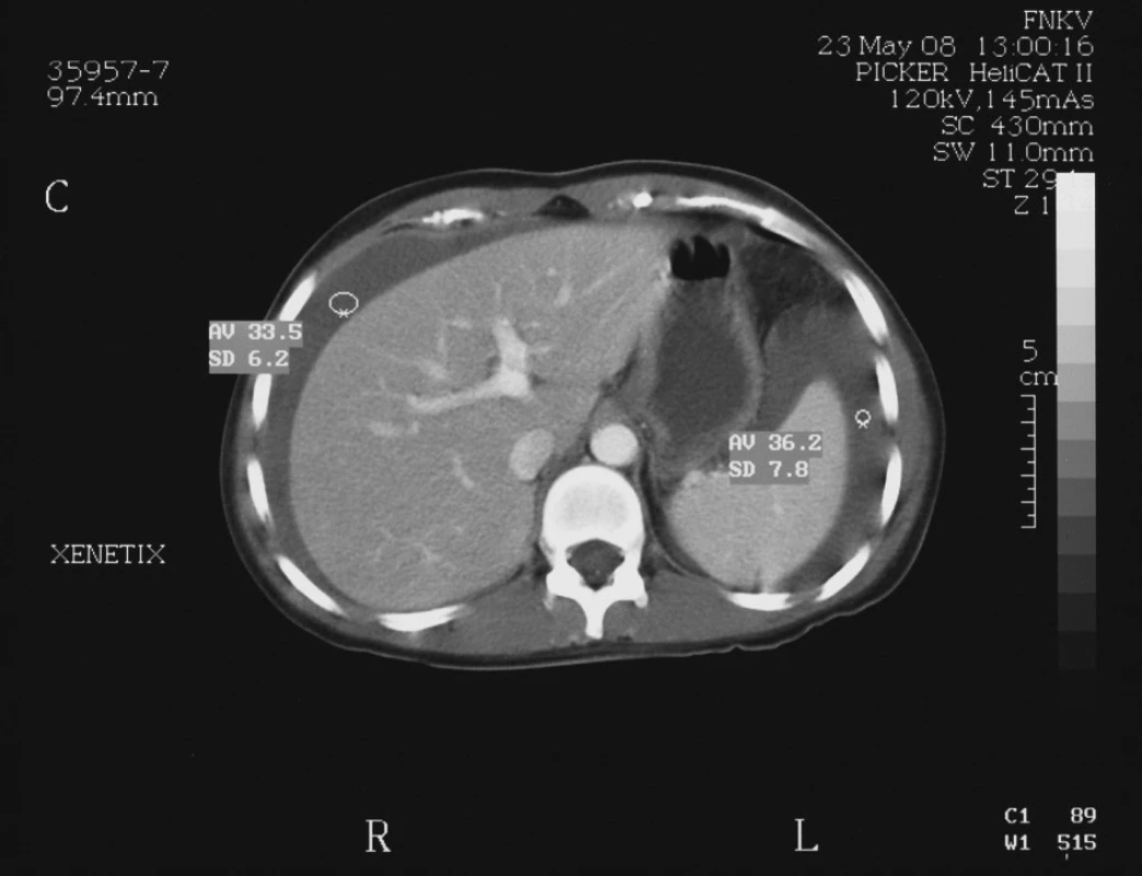 Hemoperitoneum při předávkování warfarinem
Fig. 2. Hemoperitoneum due to warfarin overdose