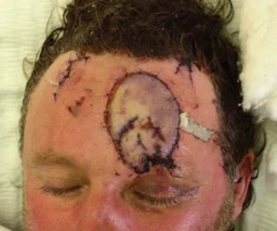 Flap ischemia 2 hrs after the dressing change. Source: archive of authors.