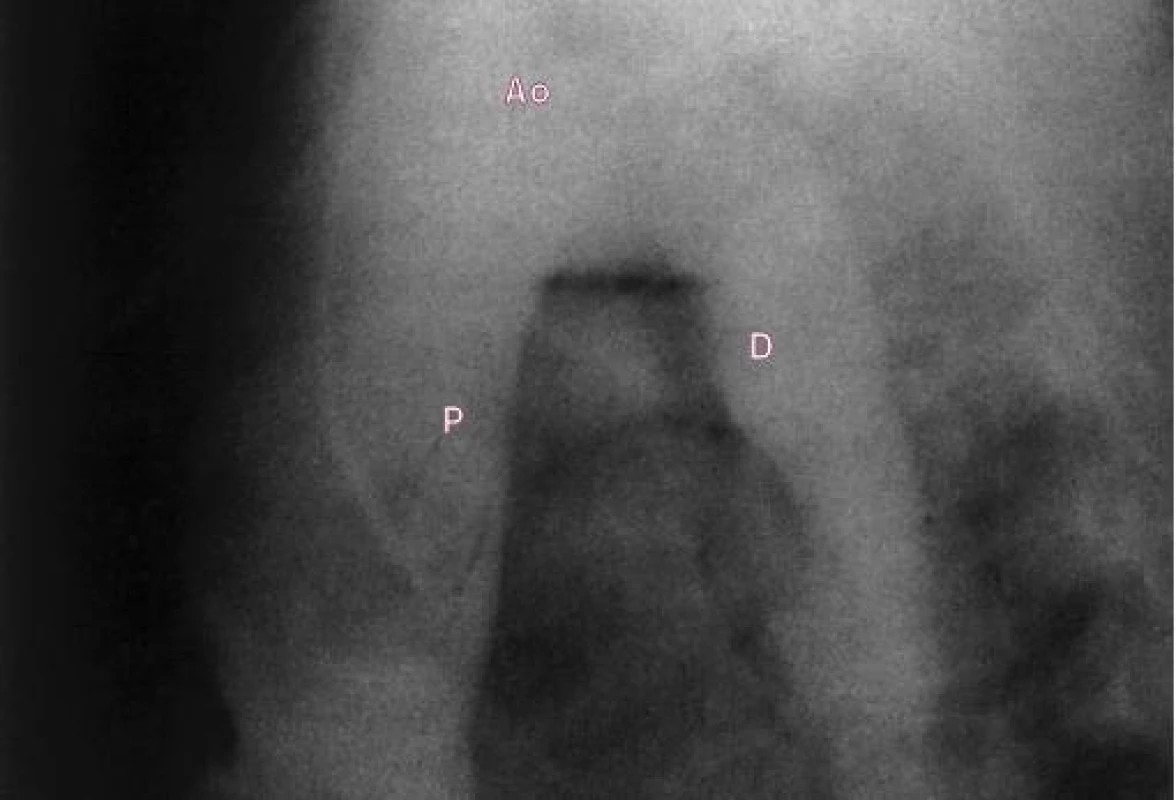 Aortogram (laterální projekce) ukazuje širokou dučej.