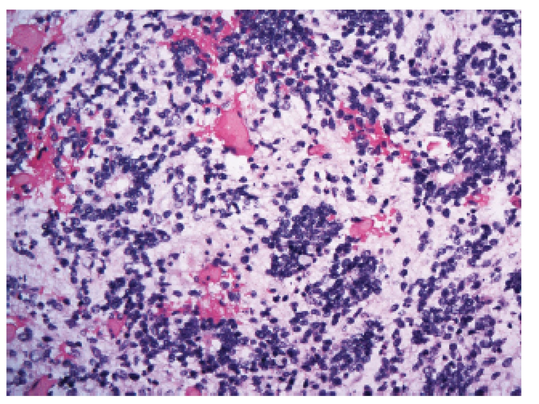 Embryonální nádor s mnohovrstevnatými rozetami (ETMR), dříve nazývaný též embryonální nádor s abundantním neuropilem a pravými rozetami (ETANTR) (200x).
