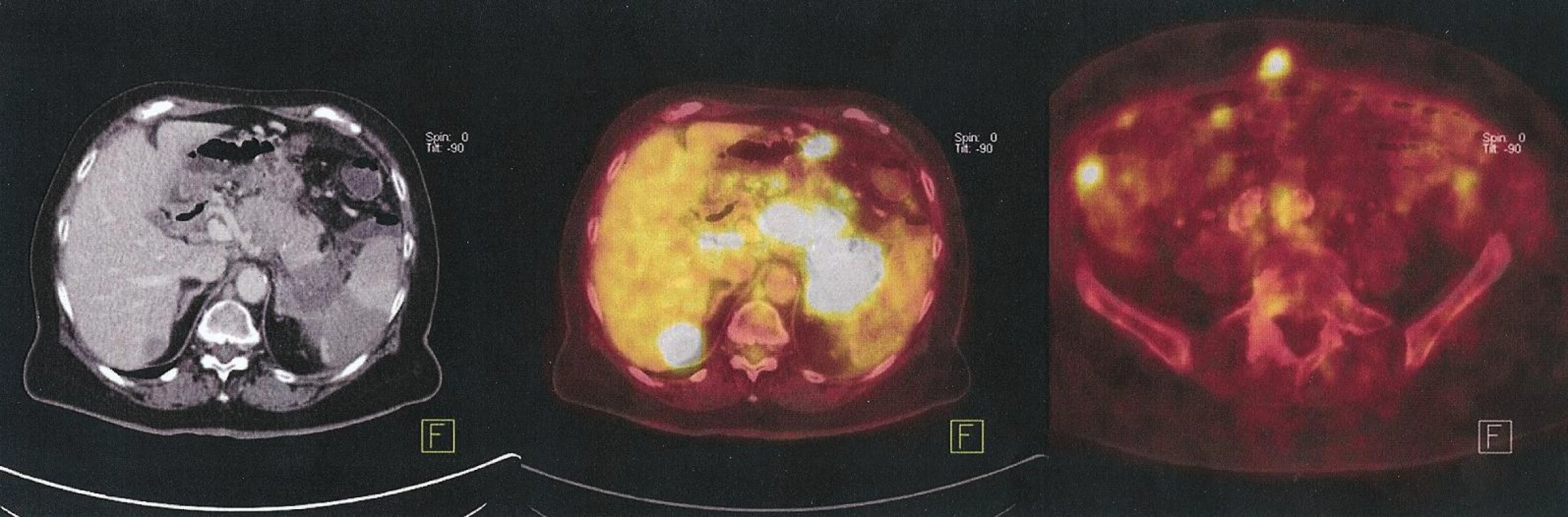 Generalizovaný karcinom kaudy pankreatu s metastázami jater a peritonea, paliativní léčba
Fig. 2. Generalized pancreatic cancer of the cauda with liver and peritoneal metastases, palliative treatment