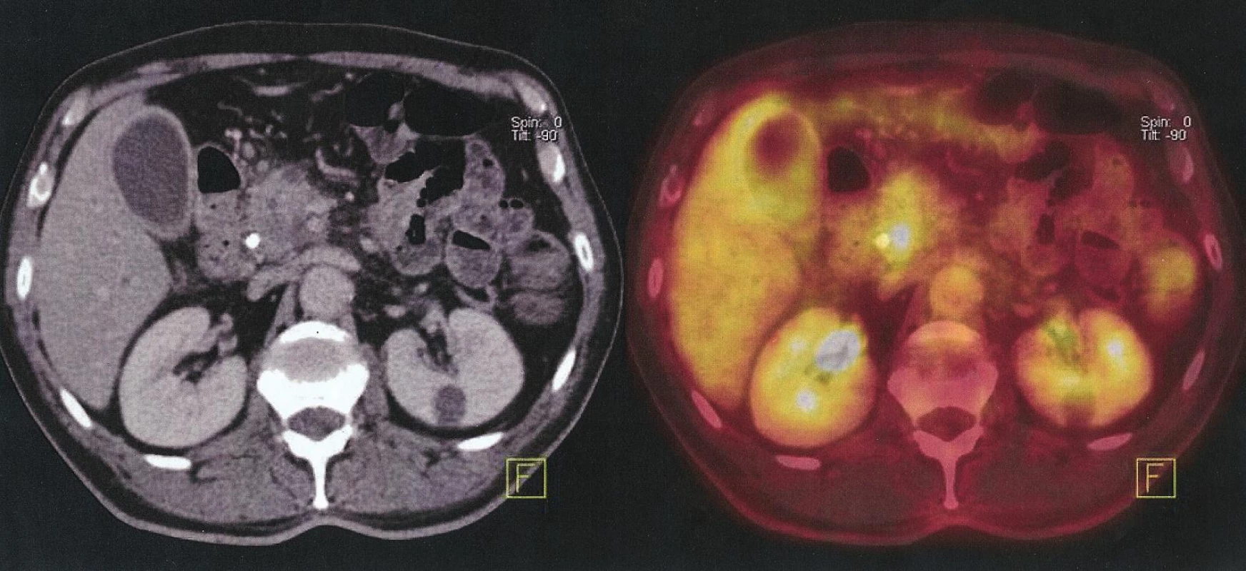 Nemocný s maligním ampulomem. Falešná pozitivita – PET/CT prokazuje metastázu jater, provedena pravostranná duodenopankreatektomie, ložisko v játrech benigní hamartom
Fig. 4. Patient with malignant ampuloma. False positive finding – PET/CT identifies liver metastases, performed right sided duodenopancreatectomy, lesion in liver is benign hamartoma
