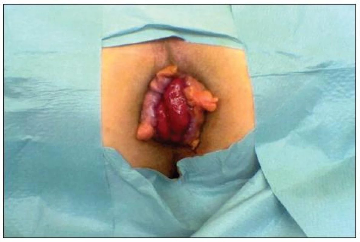 Anus před výkonem
Fig. 2. Anus before procedure