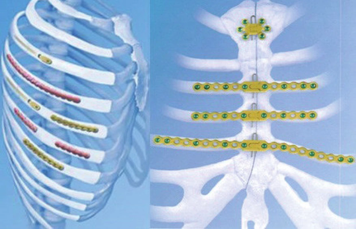 Dlahy MatrixRib a Titanium Sternal Fixation System (Synthes) in situ
Fig. 12: MatrixRib and Titanium Sternal Fixation System (Synthes) plates in situ