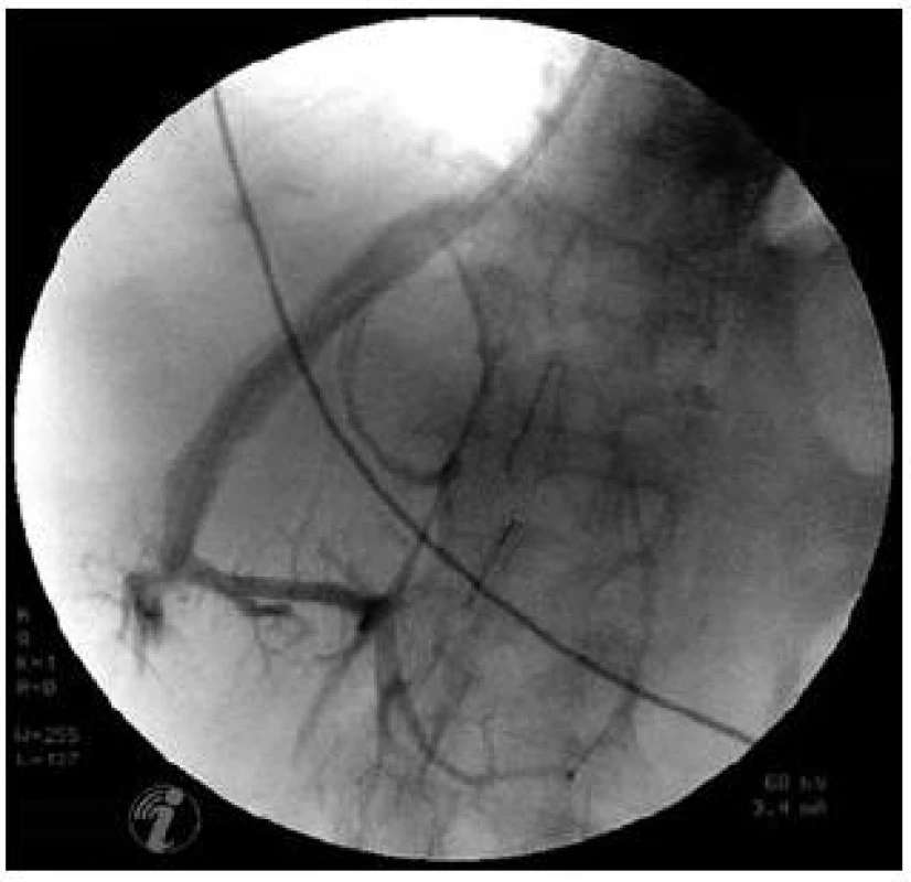 Veno-venózní spojky v jaterním parenchymu. Nástřik při katetrizaci jaterních žil.
Fig. 4. Veno-venous communication in liver parenchyma. Contrast medium injection during hepatic vein catheterization.