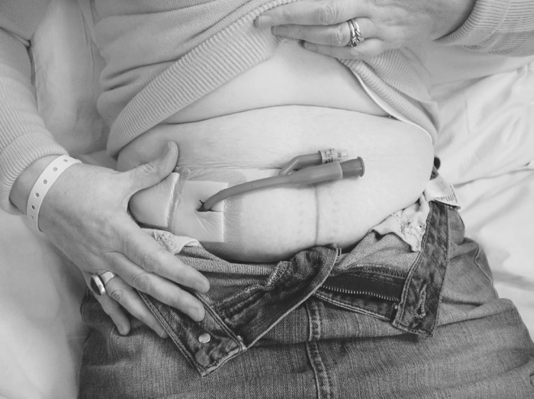 Pacientka s vloženým Foleyovým katétrem 16F
Fig. 2. A female patient with a Foley 16F catheter introduced