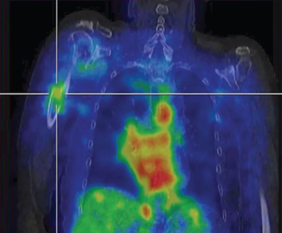 Fúze SPECT/CT hrudníku v časné fázi v koronárním řezu – zvýšený krevní pool v pravém humeru.
